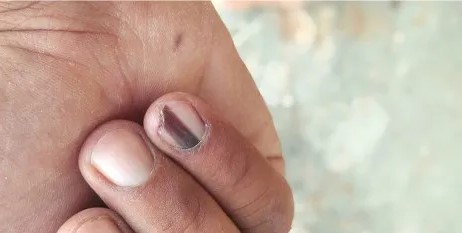 خط أسود في الأظافر.. إشارة بسيطة أم مؤشر صحي مهم؟